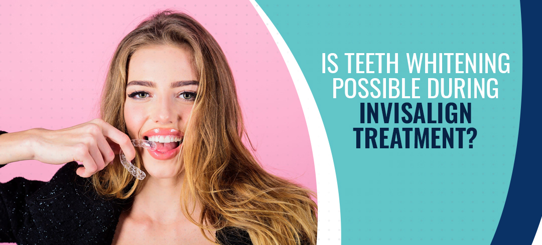can you have teeth whitening during invisalign?