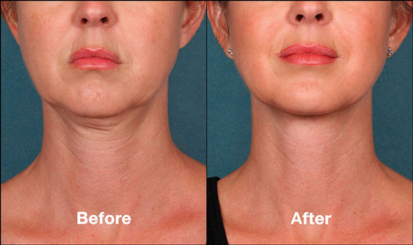 how kybella works for you?