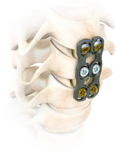 Anterior Cervical Plate with bone