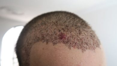 fue hair transplant side effects