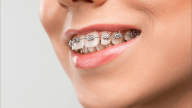 invisalign nhs