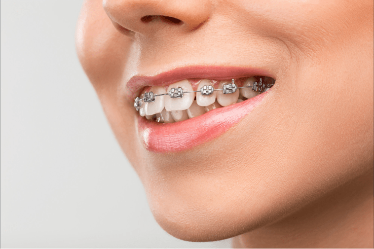 invisalign nhs