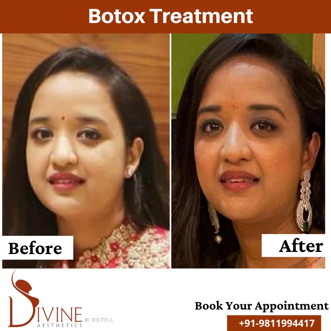 Botox Treatment