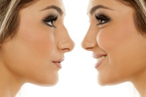 Cosmetic Surgery of the Nose