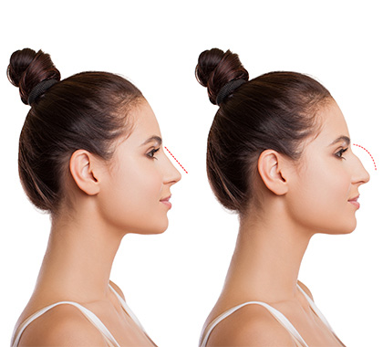 Rhinoplasty Cosmetic Surgery of the Nose