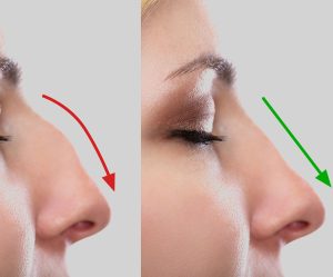 Rhinoplasty Cosmetic Surgery of the Nose