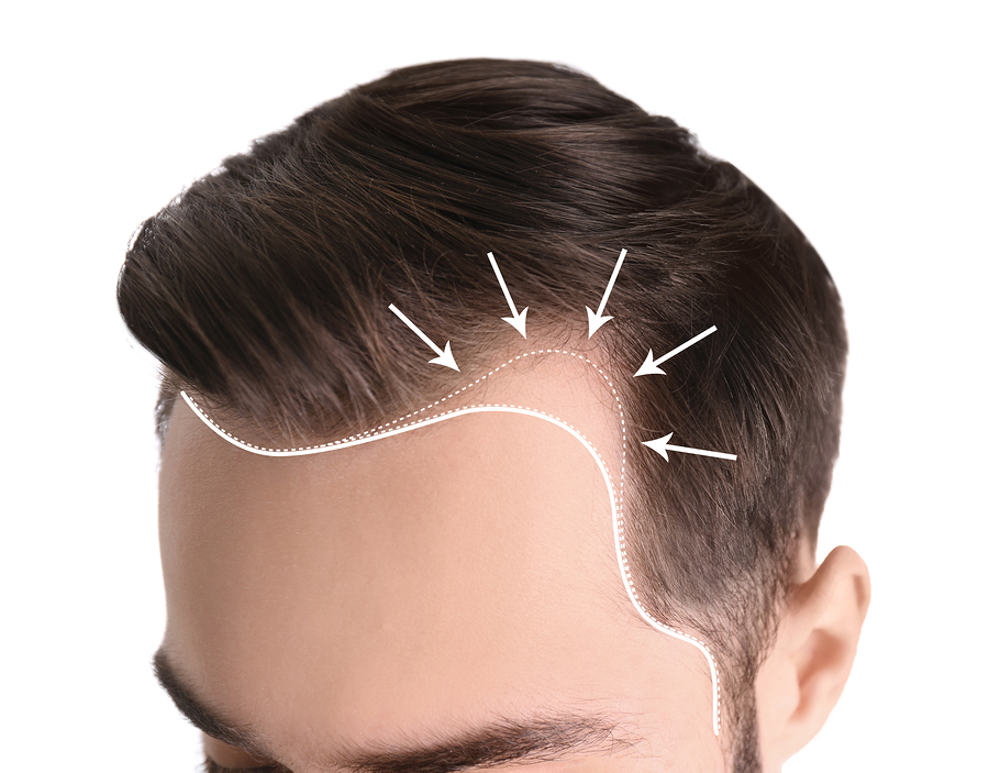 hair loss in men