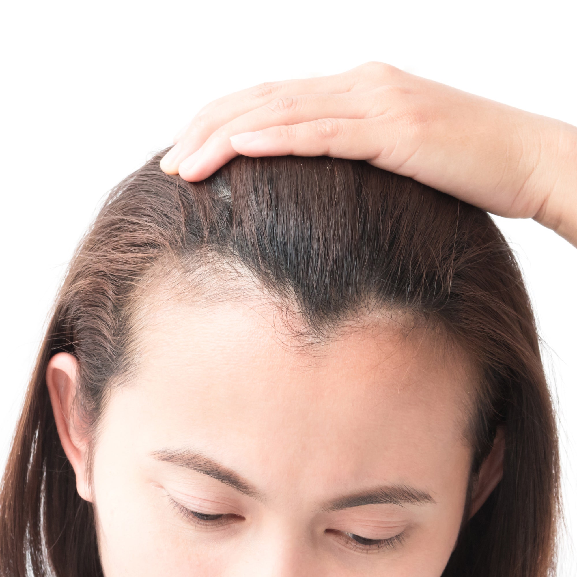 hair loss in women