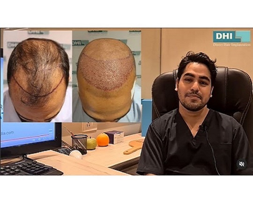 hair transplant in Bangalore