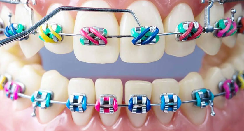 cute braces colors