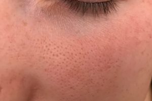 clogged-pores-and-gaps