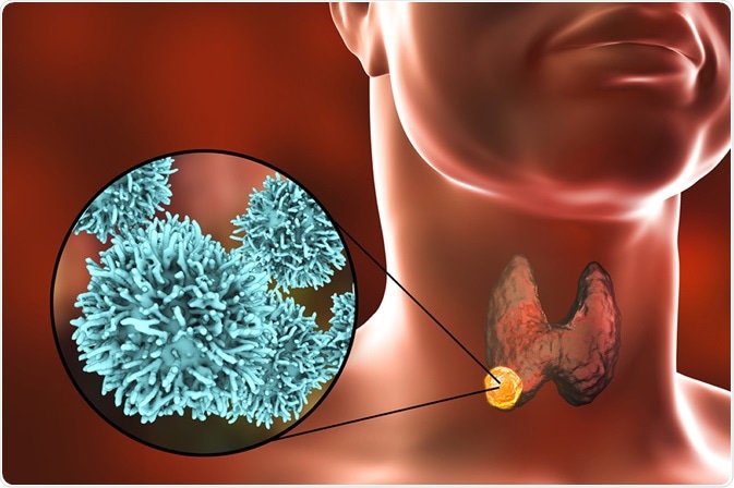 thyroid cancer