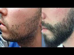 beard transplant treatment