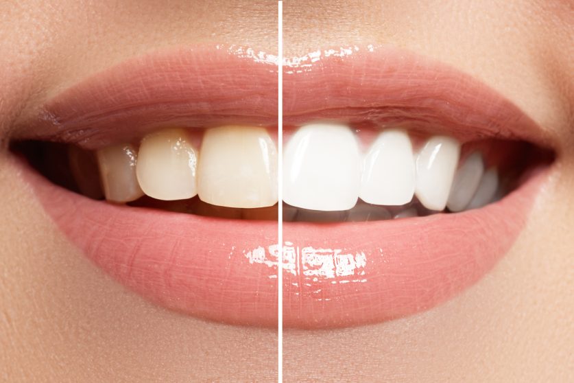 naturally whiten teeth