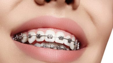 Photo of Do You Know What A Power Chain On Braces Does?
