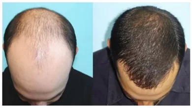 Photo of TECHNIQUES TO AID IN REGROWING HAIR