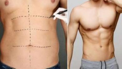 Liposuction Surgery