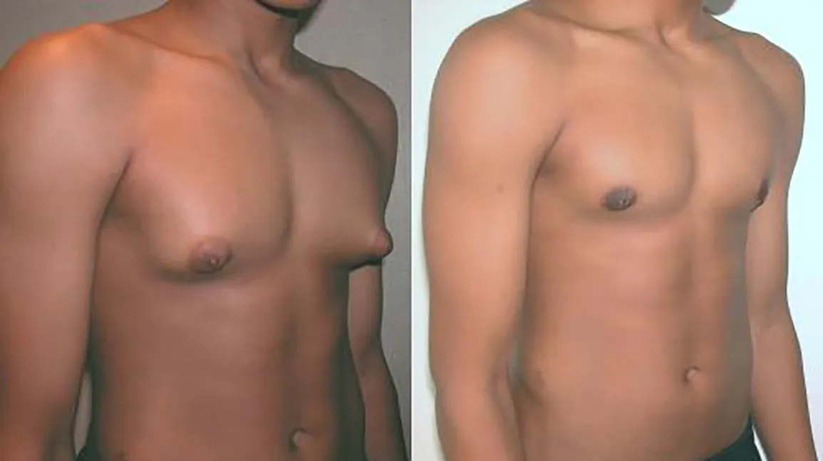 men breast reduction